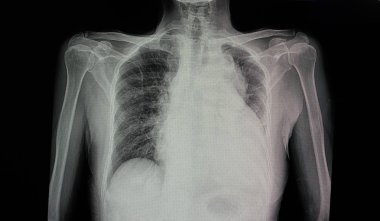 a chest x-ray film  of a patient with cardiomegaly with left side heart failure, pulmonary edema, and pericadial effusion clipart