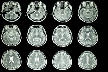MRI scan of patient brain with normal signal intensity of the brain parenchyma clipart