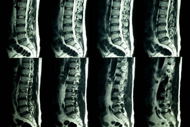 Disk dessication ve disk alanı daralma ve L3-4 disk merkezi şişkinlik ile lomber ve sakral dikenlerin dejeneratif değişim gösteren kronik sırt ağrısı olan bir hastanın lomber dikenlerin MRI taraması