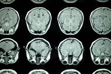 Manyetik rezonans görüntüsü, beynin MRI taraması.