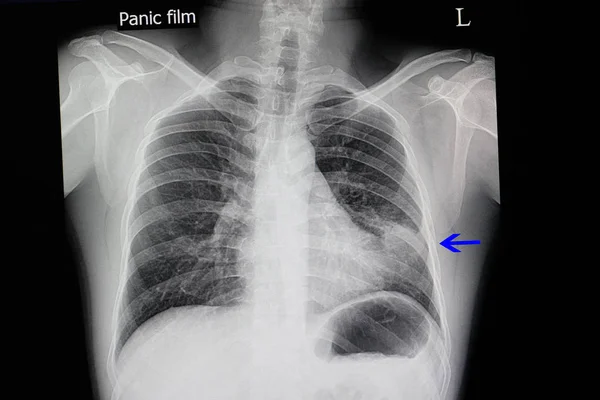 침투와 환자의 엑스레이 — 스톡 사진