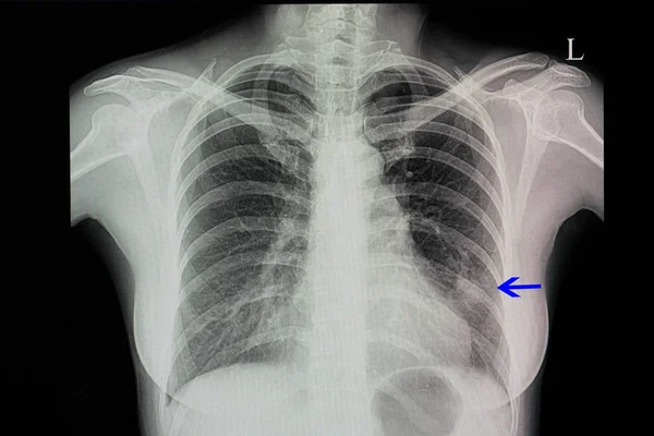 Una Radiografía Tórax Paciente Con Neumonía Con Infiltración Pulmonar Inferior — Foto de Stock