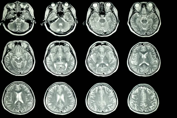 Resonancia Magnética Del Cerebro Del Paciente Con Intensidad Señal Normal — Foto de Stock