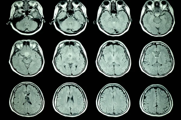 Resonancia Magnética Del Cerebro Del Paciente Con Intensidad Señal Normal — Foto de Stock