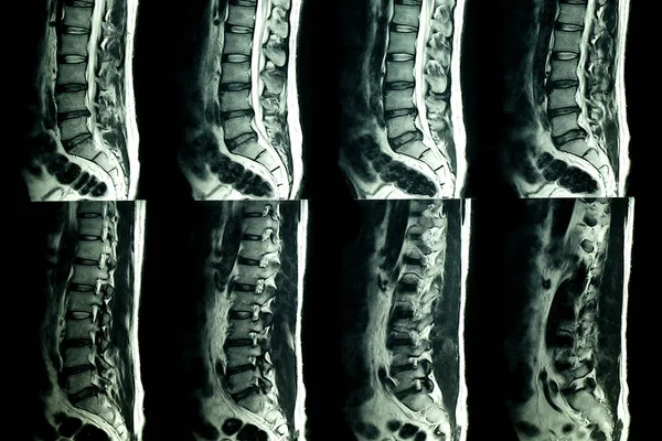 Resonancia Magnética Las Espinas Lumbares Paciente Con Dolor Lumbar Crónico — Foto de Stock