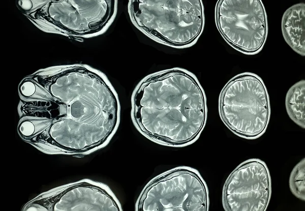 magnetic resonance image, mri scan of the brain