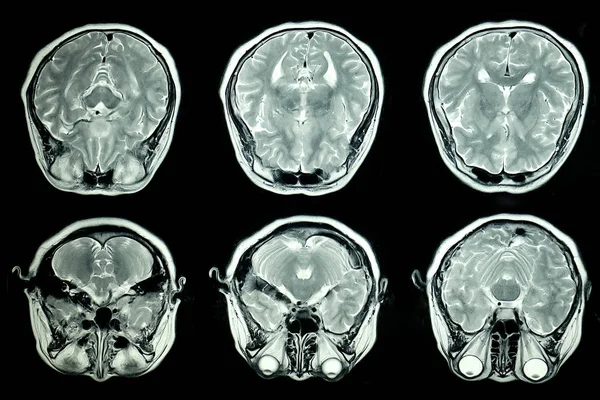 Магнитно Резонансное Изображение Мрт Мозга — стоковое фото