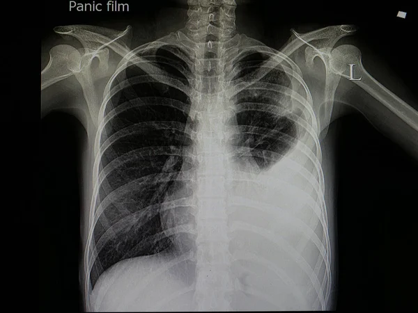 Ray Film Beteg Tüdőgyulladás Bal Többes Folyadékgyülem — Stock Fotó