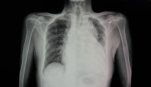 œdeme Pulmonaire Images Libres De Droit Photos De œdeme Pulmonaire Depositphotos