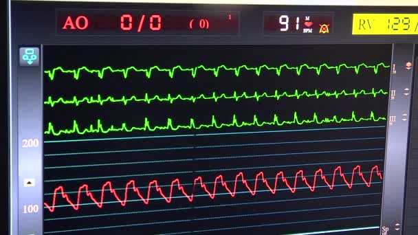 Práce kardiologického monitoru na operačním sále — Stock video