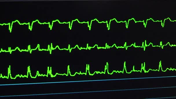 Il lavoro di un cardiofrequenzimetro in sala operatoria — Video Stock