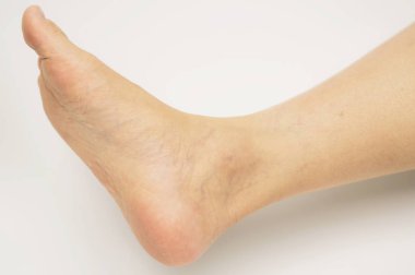 Closeup topuklar ve varis Asyalı kadın bacak ve ayak bileği kopya alanı ile beyaz arka plan üzerinde izole kırık. Yüksek topuklu giyen gelen sorun.