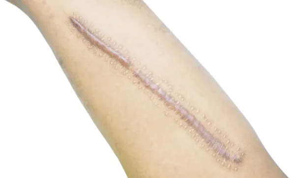 Cicatriz queloide de primer plano en la piel del hombre asiático después de una fractura de fémur, muslo roto sobre fondo blanco con espacio para copiar . — Foto de Stock