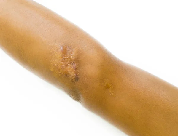Cicatriz queloide de primer plano en el codo de piel de hombre asiático después de accidente de motocicleta sobre fondo blanco con espacio de copia . — Foto de Stock