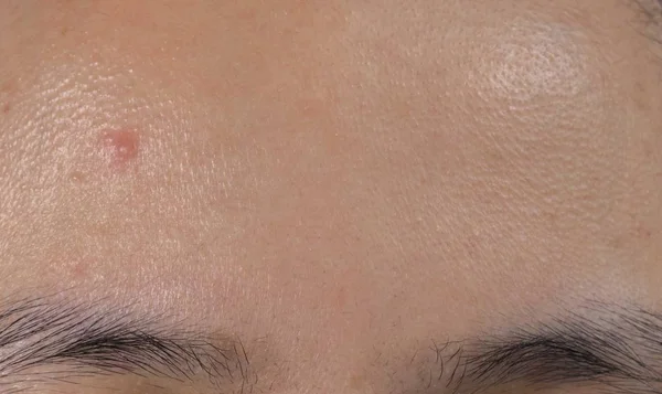 El acné en la frente de la piel grasa mujer asiática. Cercano comedones . — Foto de Stock
