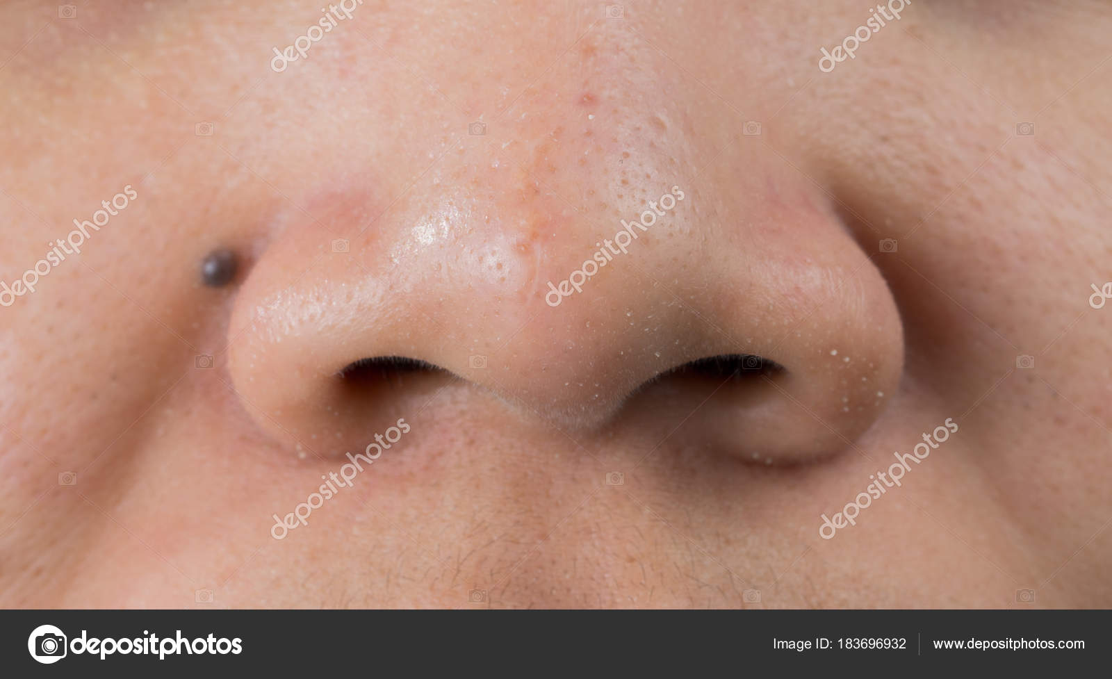 peroxyde de benzoyle cicatrice acné peroxyde de benzoyle cicatrice acné
