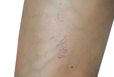 Macro shot of spider veins on woman leg skin on white background. Concept before sclerotherapy or laser surgery to remove spider veins. Spider veins need to use compression stockings.  clipart