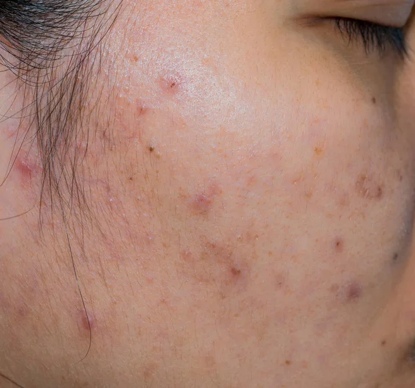 Acne e acne mancha na pele de cara oleosa da mulher asiática. Conceito antes do tratamento da acne e tratamento a laser de face para se livrar da mancha escura pós-acne. Comedões fechados e comedões abertos na pele facial — Fotografia de Stock