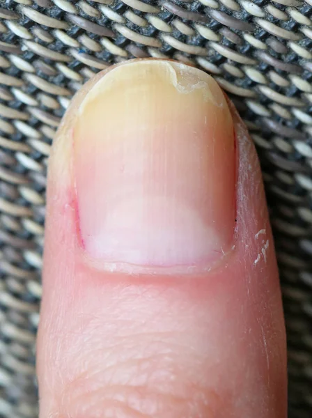 Splitting finger nail — Stock Photo, Image