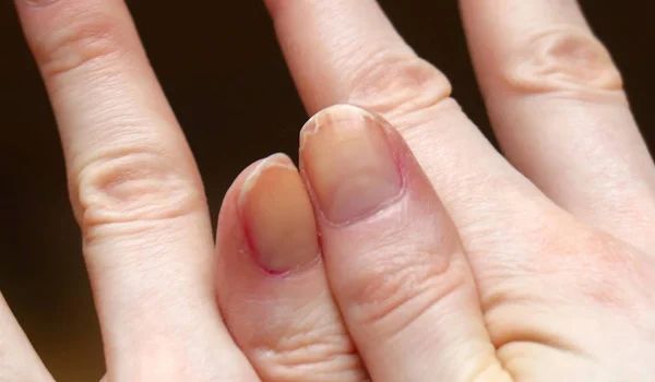 Cracked fingernails close up — Stock Photo, Image
