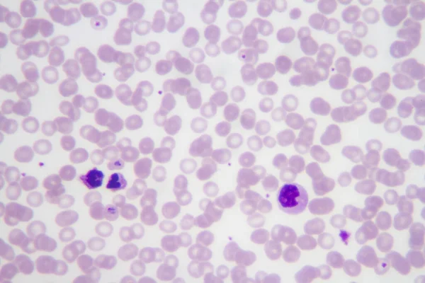 Мазок Крови Малярийного Паразита Plasmodium Vivax — стоковое фото