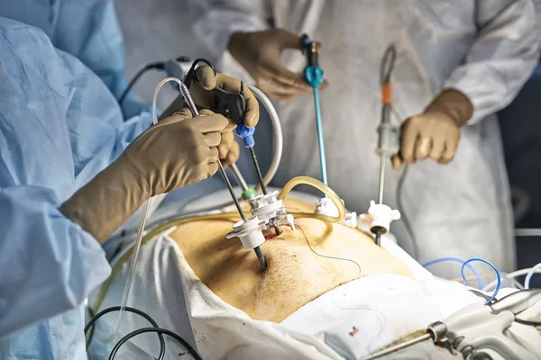 Proceso de operación de laparoscopia — Foto de Stock