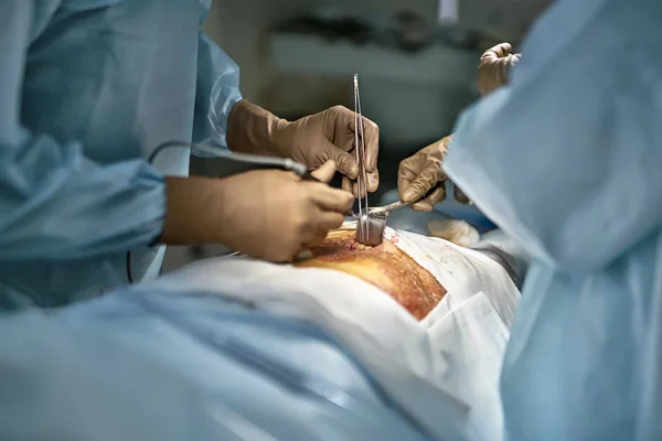 Processus d'opération abdominale — Photo