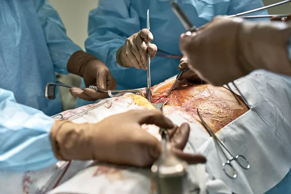 Processo de operação abdominal — Fotografia de Stock