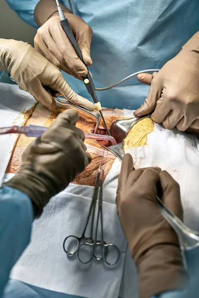 Abdominal operation process — Stock Photo, Image