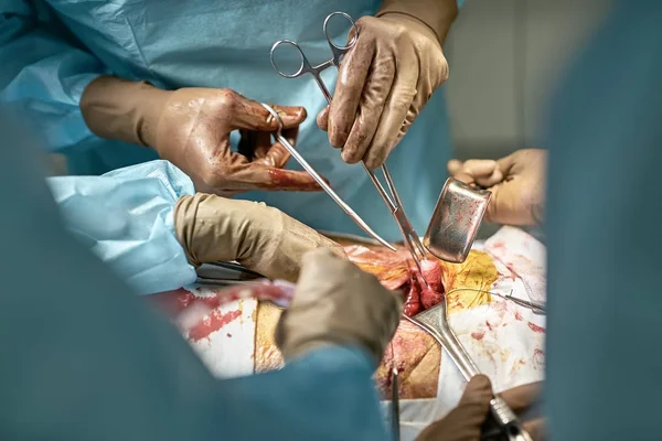 Processo de operação abdominal — Fotografia de Stock