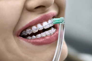 Braket sistemi ile kadın dişleriyle yakın çekim görünümü
