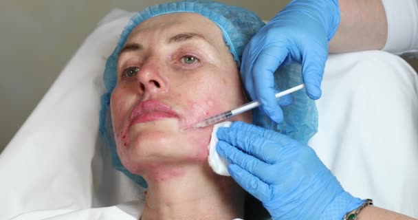 Enjeksiyon ile kozmetik tedavi — Stok video