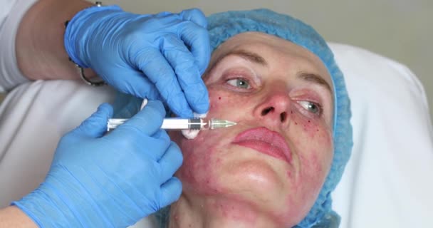 Cosmetische behandeling met injectie — Stockvideo