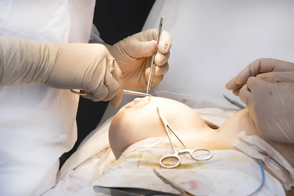 Proces operace pro zvýšení ženské poprsí — Stock fotografie
