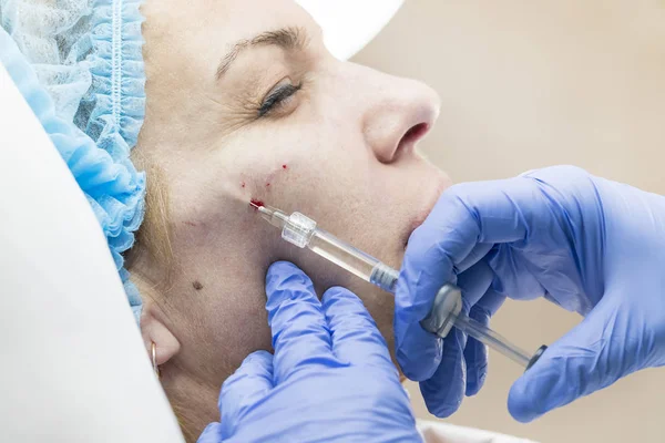 Cosmetic treatment with injection — Stock Photo, Image