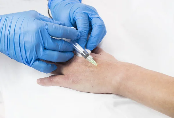 Διαδικασία μεσοθεραπείας σε ένα γυναικείο χέρι — Φωτογραφία Αρχείου