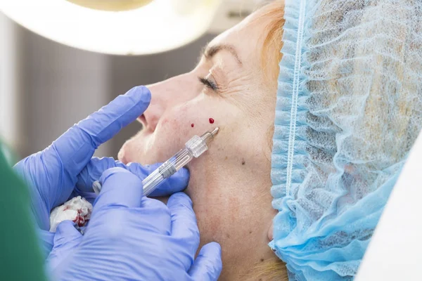 Een volwassen vrouw ondergaat cosmetische chirurgie — Stockfoto