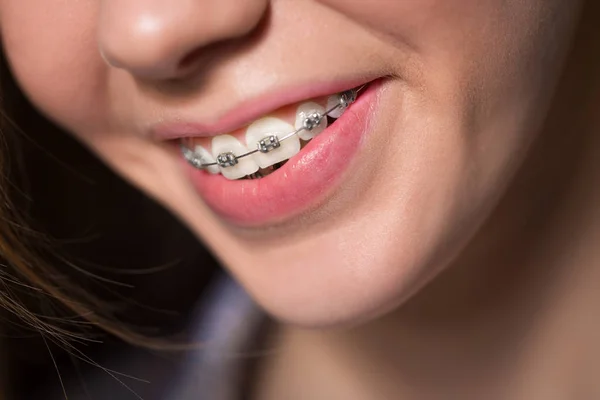 Hermosa Joven Rubia Mostrando Sus Frenos Dentales Aislados Blanco —  Fotos de Stock