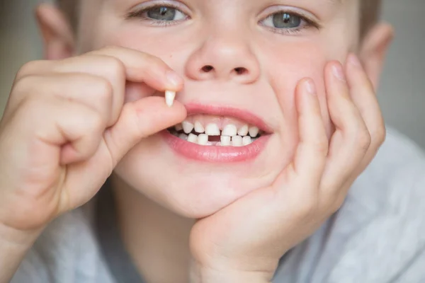 Criança adolescente com um dente retirado — Fotografia de Stock