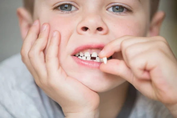 Adolescente niño con un diente caído — Foto de Stock