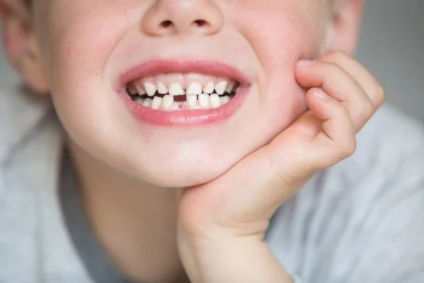 Tiener kind met een tand afgehaakt — Stockfoto