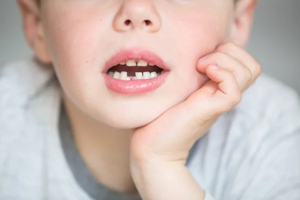 Criança adolescente com um dente retirado — Fotografia de Stock