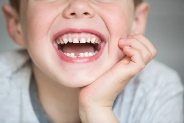 Criança adolescente com um dente retirado — Fotografia de Stock