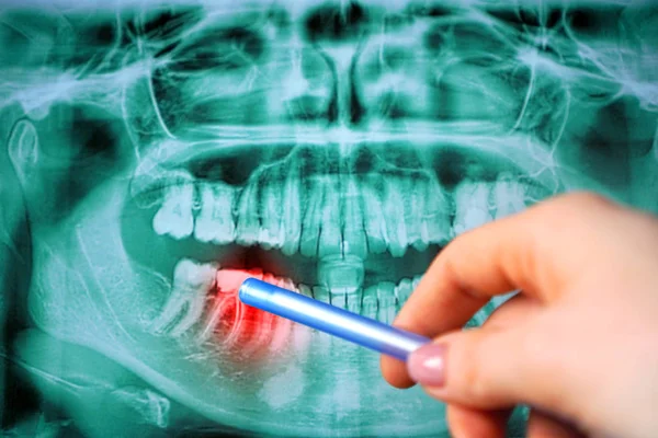 Panoramiczne Prześwietlenie Zębów Problemem Zęba Ognisko Stomatologiczne — Zdjęcie stockowe
