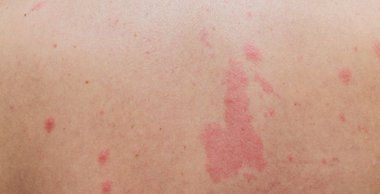 Anti döküntü, etrafında geri görünümü kadar insan dermatit sorunu döküntü, Anti döküntü ve sağlık sorunu olan kapatın.