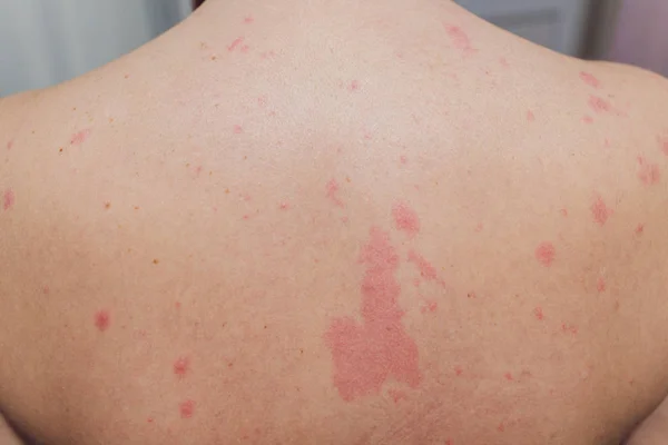 Close up Allergy rash, Around Back view of human with dermatitis problem of rash ,Allergy rash and Health problem. — Stock Photo, Image