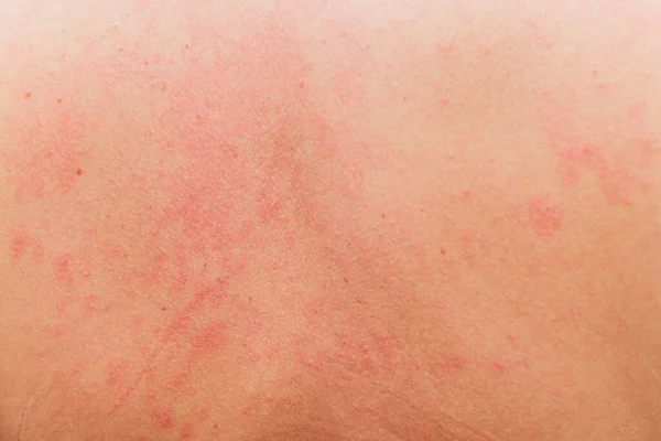 Éruption cutanée allergique sur le corps du patient . — Photo