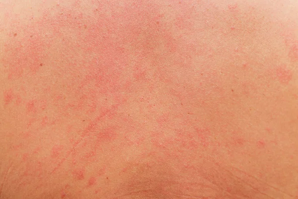 Allergic rash on the body of the patient. — Stock Photo, Image