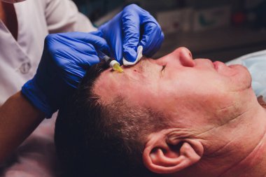 Bir estetik cerrahın elleri hastaların yüzüne hatlar çizer. yüz plastiği prosedürü için.