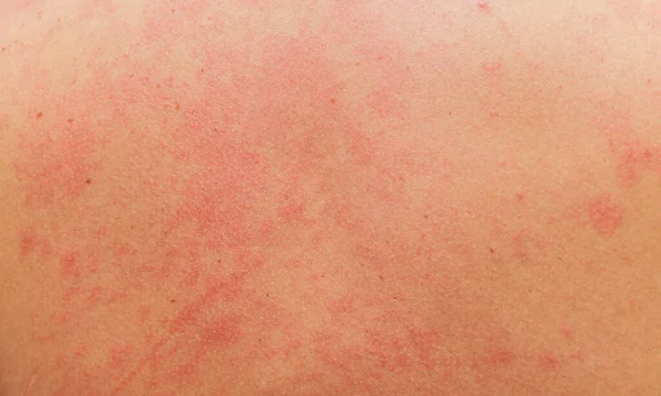 Аллергическая сыпь на теле пациента . — стоковое фото